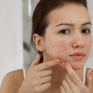 Pele-Acneica-como-prevenir-a-acne-e-cuidar-desse-tipo-de-pele-1-scaled-e1654864206472